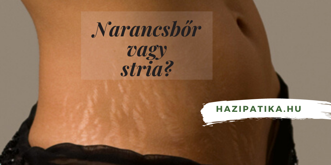 Narancsbőr vagy pedig stria? Mi a különbség?