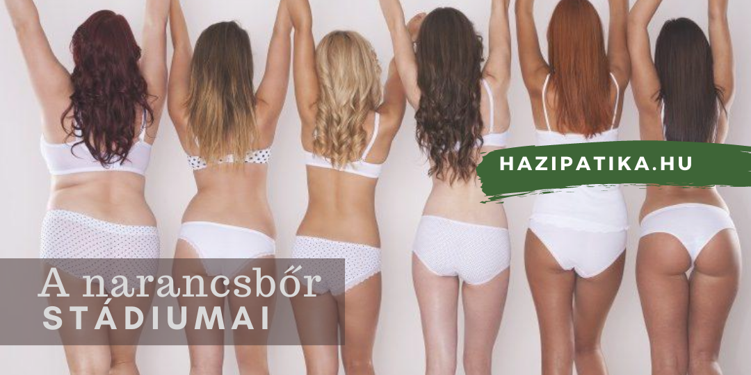A narancsbőr típusai, stádiumai