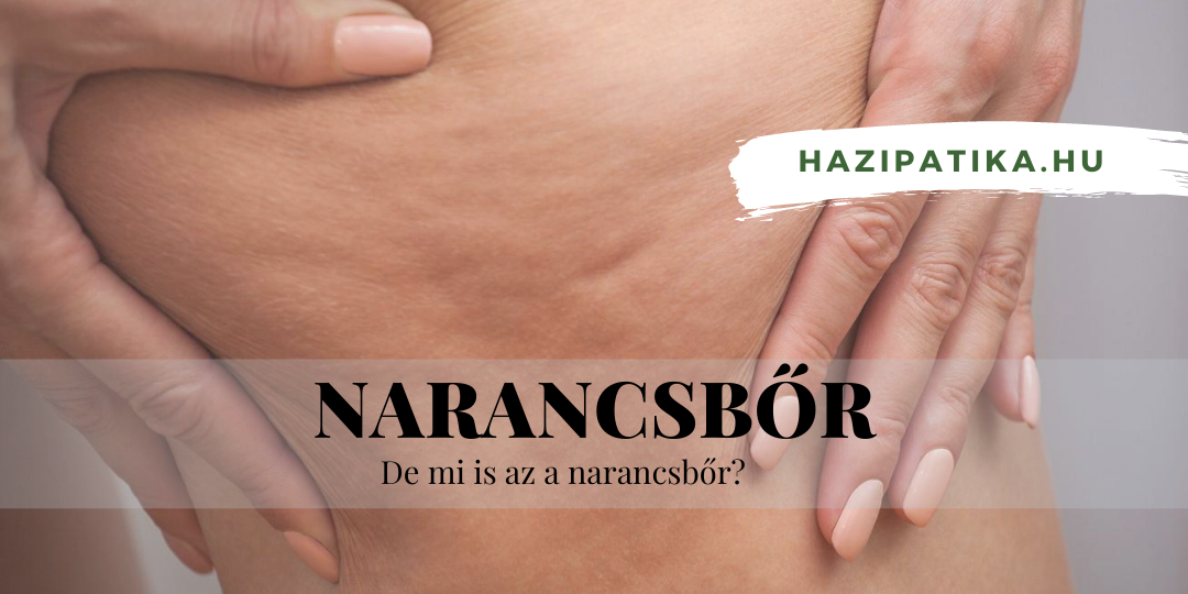 A nagy kérdés, mitől alakul ki a narancsbőr?